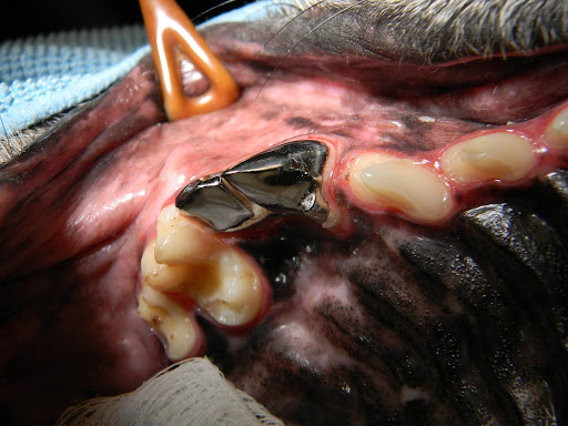 A metal (talladium) crown that has been cemented in place on an upper 4th premolar after it was treated with root canal therapy.