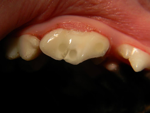 Finished root canal procedure on an upper 4th premolar.