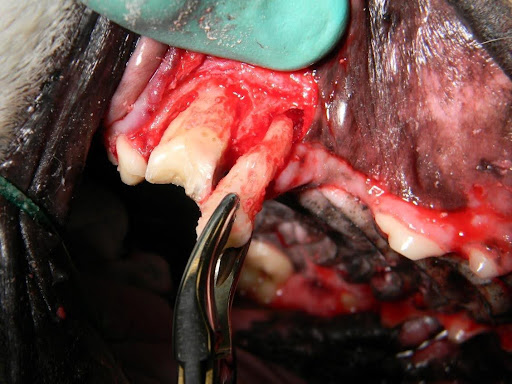 Intra-op image of an upper 4th premolar with a slab fracture being extracted.