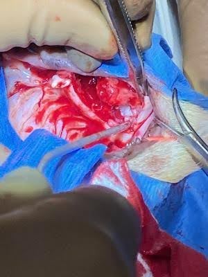 impacted tooth extraction